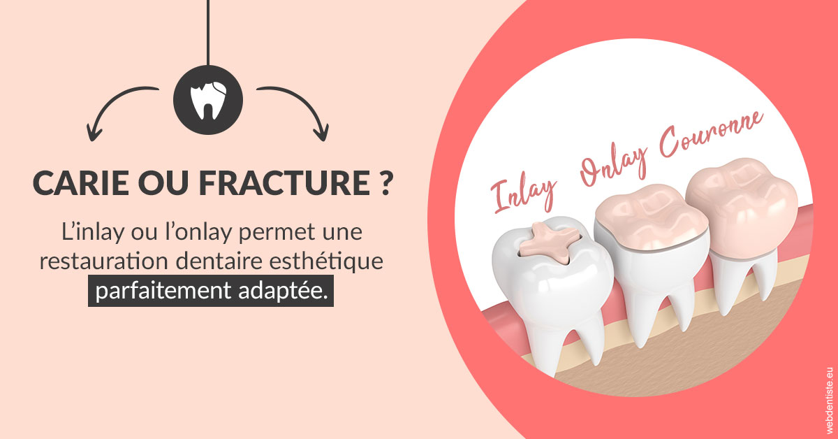 https://dr-teysseire-olivier.chirurgiens-dentistes.fr/T2 2023 - Carie ou fracture 2