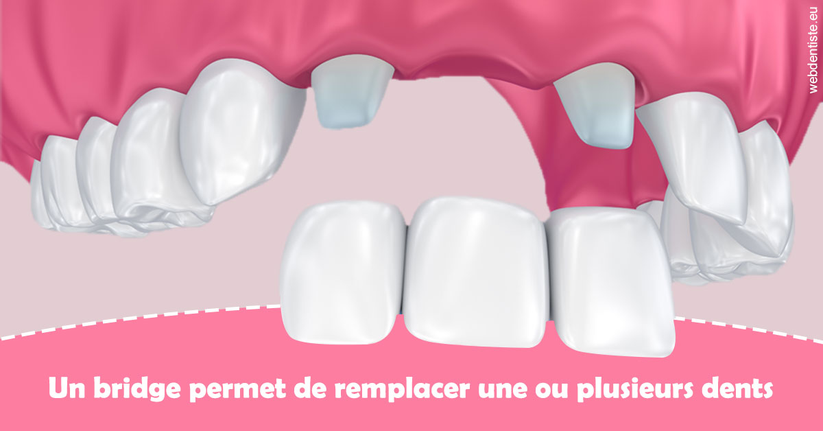https://dr-teysseire-olivier.chirurgiens-dentistes.fr/Bridge remplacer dents 2