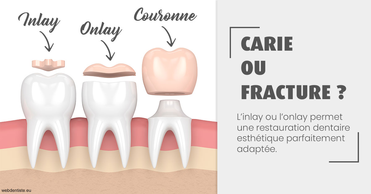 https://dr-teysseire-olivier.chirurgiens-dentistes.fr/T2 2023 - Carie ou fracture 1