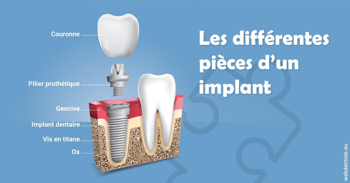 https://dr-teysseire-olivier.chirurgiens-dentistes.fr/Les différentes pièces d’un implant 1